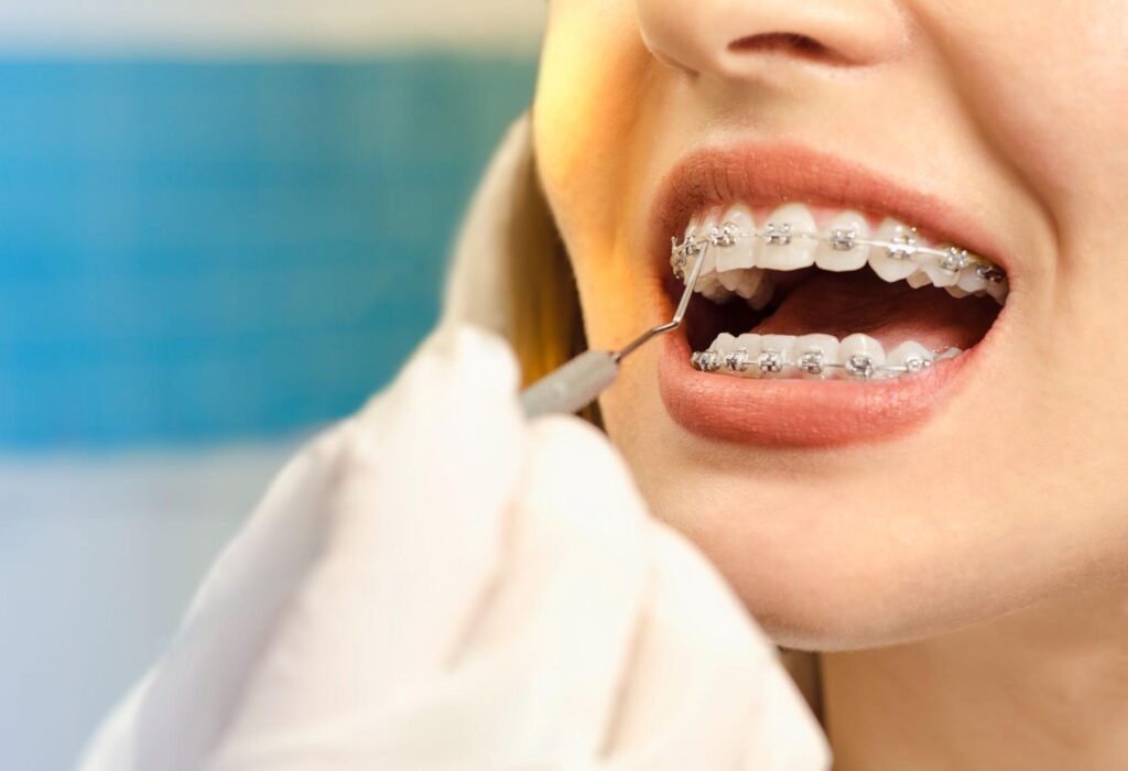 How to Use Your HSA/FSA for Orthodontics