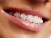 clearbraces